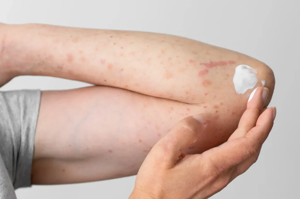 Seboreik Dermatit Tedavisi - İstanbul Dermatolog