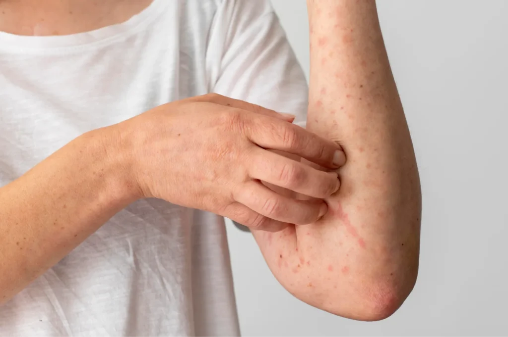 Seboreik Dermatit Nedenleri - İstanbul Dermatolog