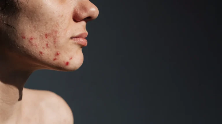 Akne Tedavisi Nedir ? İstanbul Dermatolog