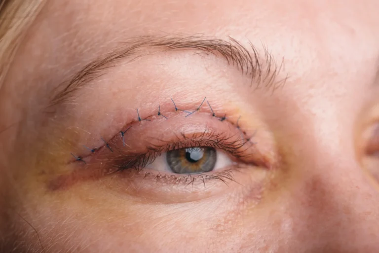 Ameliyatsız Göz Kapağı Estetiği - İstanbul Dermatolog