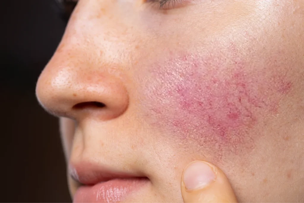 Gül Hastalığı Nedir ? Gül Hastalığı Tedavisi İstanbul Dermatolog