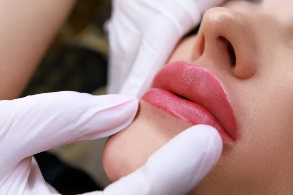 Russian Lips Dudak Dolgusu İstanbul Dermatolog