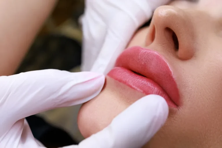 Russian Lips Dudak Dolgusu İstanbul Dermatolog