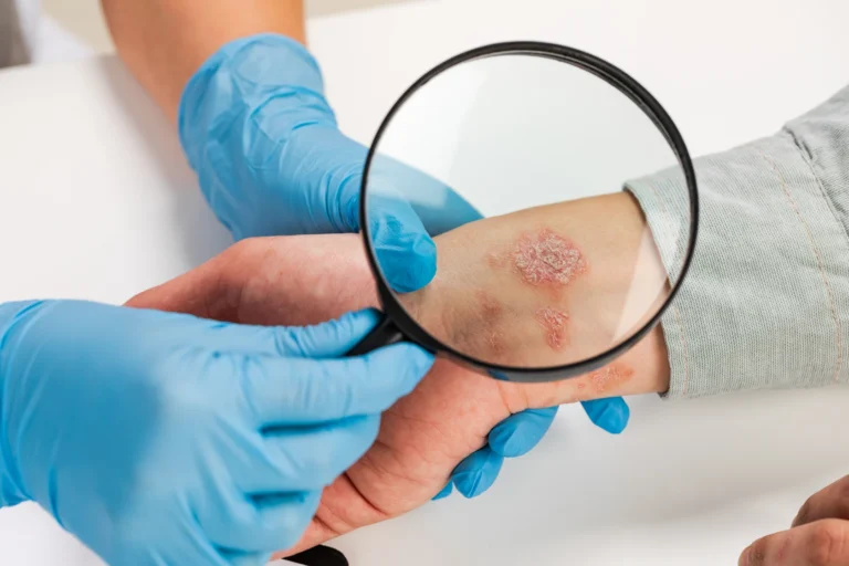 Sedef Hastalığı Nedir? - İstanbul Dermatolog